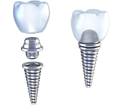 Dental Implants