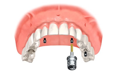 Implant Supported Denture