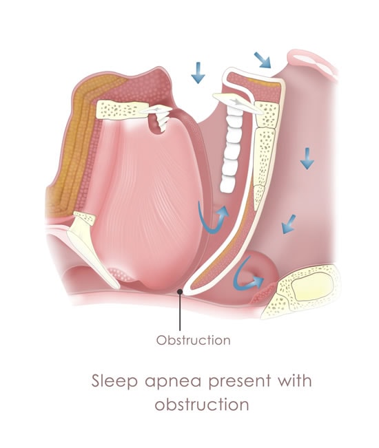 Sleep Apnea Visual Cross-Section