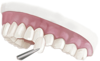 Porcelain Veneers Illustration