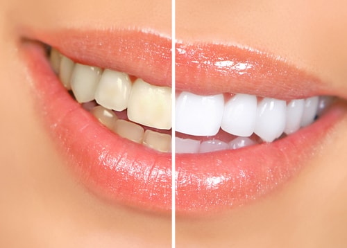 Teeth Whitening in Columbus OH