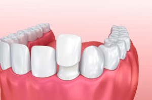 What Are Dental Veneers