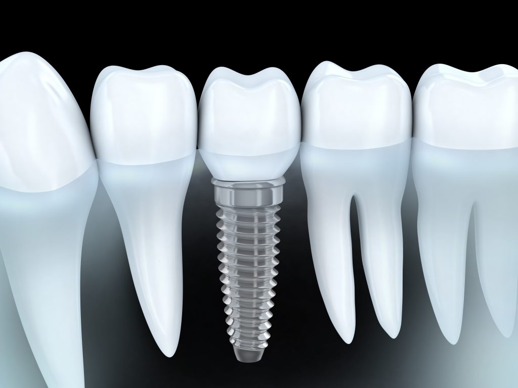 Dental Implant Rendering 