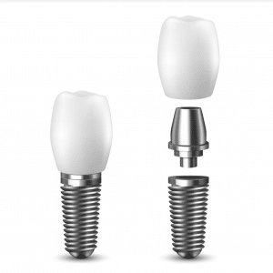 dental implants